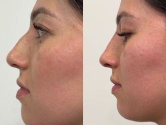 Rinomodelación antes y después - 878507