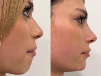 Rinomodelación antes y después - 878508