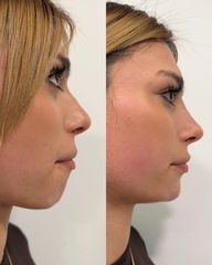 ✨ ANTES Y DESPUÉS de un tratamiento de Rinomodelación + Mentón ✨