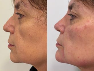 Rellenos faciales antes y después - 878509