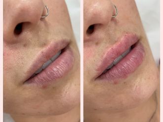 Aumento labios antes y después - 878510