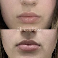 Aumento de labios - Clínica Riba