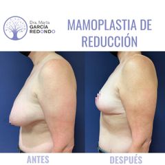 Reducción senos - Dra. Marta García Redondo