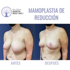 Reducción senos - Dra. Marta García Redondo