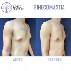 Ginecomastia - Dra. Marta García Redondo
