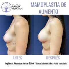 Aumento de pecho - Dra. Marta García Redondo
