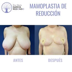 Reducción senos - Dra. Marta García Redondo