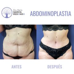 Abdominoplastia - Dra. Marta García Redondo