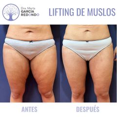 Lifting muslos - Dra. Marta García Redondo