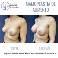 Aumento de pecho - Dra. Marta García Redondo