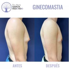 Ginecomastia - Dra. Marta García Redondo