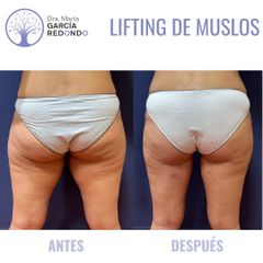 Lifting de muslos - Dra. Marta García Redondo