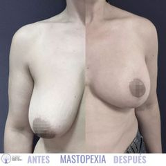 Mastopexia - Dra. Marta García Redondo