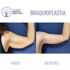 Braquioplastia - Dra. Marta García Redondo