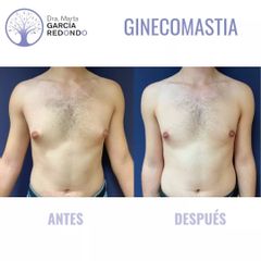 Ginecomastia - Dra. Marta García Redondo