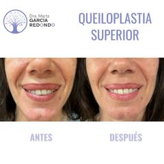Queiloplastia - Dra. Marta García Redondo