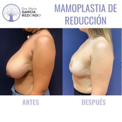 Reducción senos - Dra. Marta García Redondo