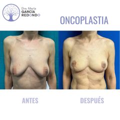 Oncoplastia - Dra. Marta García Redondo
