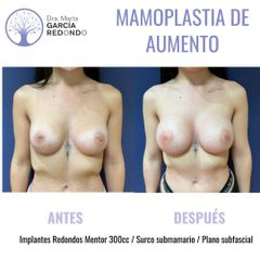 Aumento de pecho - Dra. Marta García Redondo