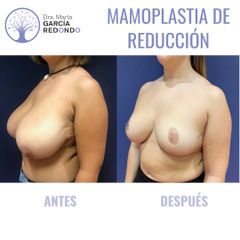 Reducción senos - Dra. Marta García Redondo