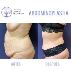 Abdominoplastia - Dra. Marta García Redondo