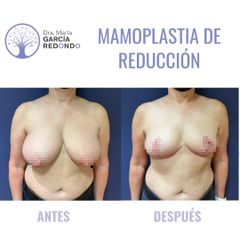 Reducción senos - Dra. Marta García Redondo