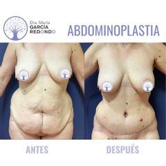 Abdominoplastia - Dra. Marta García Redondo