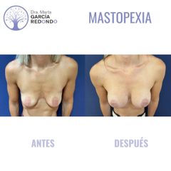Mastopexia - Dra. Marta García Redondo