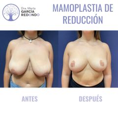 Reducción senos - Dra. Marta García Redondo