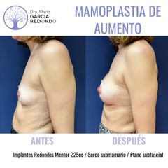 Aumento de pecho - Dra. Marta García Redondo
