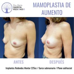 Aumento de pecho - Dra. Marta García Redondo