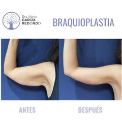 Braquioplastia - Dra. Marta García Redondo