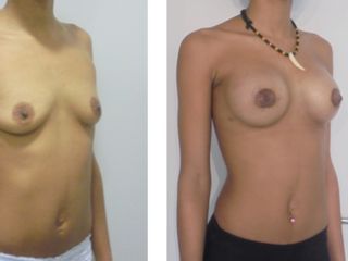 Antes y después Aumento de pecho