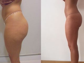 Antes y después Liposucción