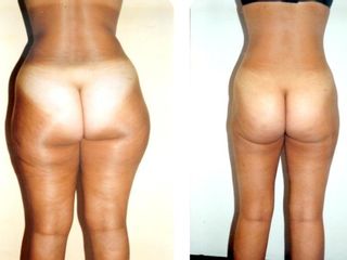 Antes y después Liposucción