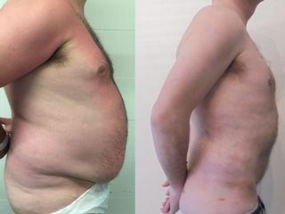 Liposucción de abdomen - Clínica Sanza