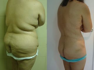 Liposucción de abdomen - Clínica Sanza