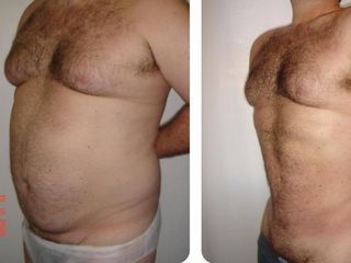 Liposucción de abdomen - Clínica Sanza