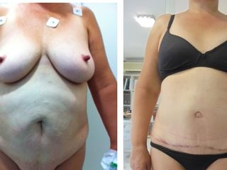 Antes y después Abdominoplastia
