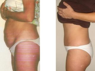 Antes y después Abdominoplastia