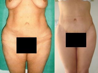 Antes y después Abdominoplastia