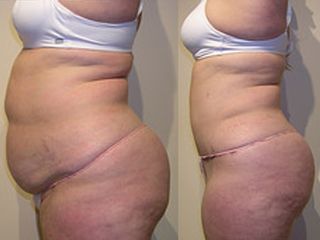 Antes y después Abdominoplastia