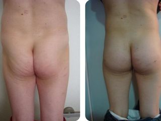 Antes y después Aumento de glúteos