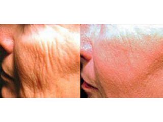 Antes y después Rejuvenecimiento facial