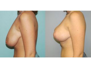 Antes y después Mastopexia 