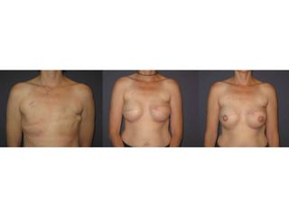 Antes y después Reconstrucción mamaria