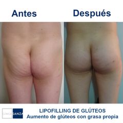 Aumento glúteos - Clínica Sanza