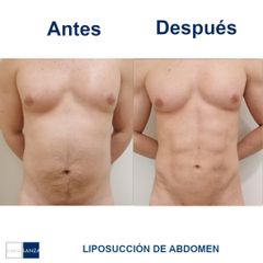 Liposucción de abdomen - Clínica Sanza