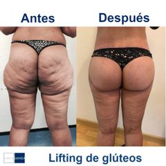 Lifting de glúteos - Clínica Sanza