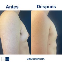 Ginecomastia - Clínica Sanza
